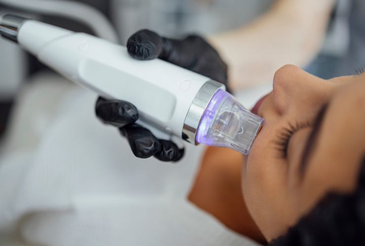 Microneedle Radiofrequency (RF Microneedle)
